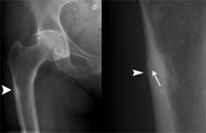 Atypical femoral fractures and bisphosphonate therapy