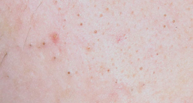 Acne management in primary care