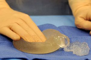 Breast Implant Removal Surgery, Saint Joseph Hospital, Paris, France - 05 Jan 2012