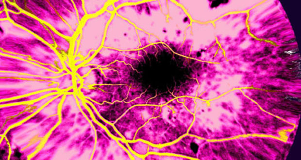 DIABETIC RETINOPATHY