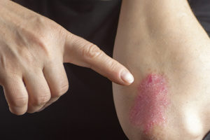 Psoriasis-4961569991