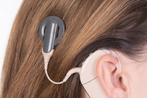 Cochlear-implant-464470338