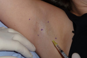Botox-injection-into-Axilla