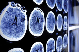 mri-scan-ThinkstockPhotos-522951239
