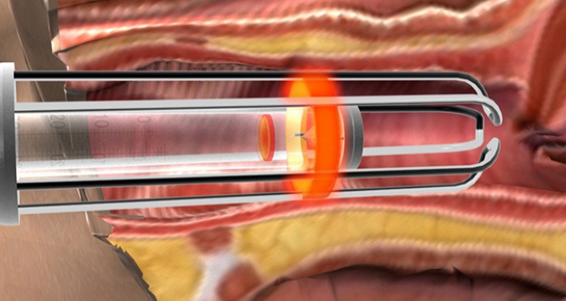 New laser treatment for stress urinary incontinence