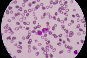 abnormal-cells-ThinkstockPhotos-494762512