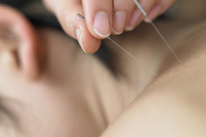 acupuncture-ThinkstockPhotos-87159250