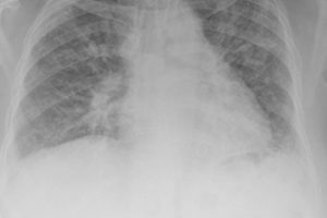 cystic-fibrosis-ThinkstockPhotos-182502752