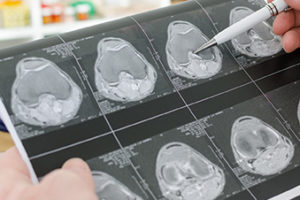 cancer-ThinkstockPhotos-484615590