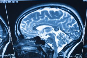 Brain-MRI-ThinkstockPhotos-483960857web