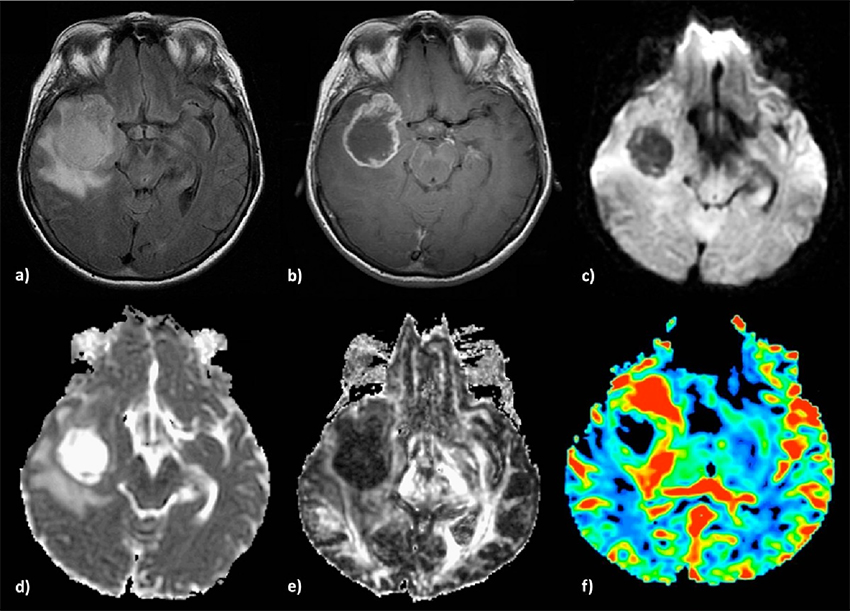 glioblastoma-new-targets-for-treatment-with-brain-cancer-cells