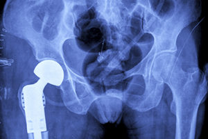 hip-replacement-ThinkstockPhotos-522924695