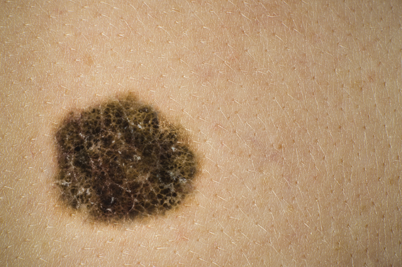 Learning your ABCDEs of melanoma