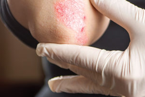 Psoriasis on elbow