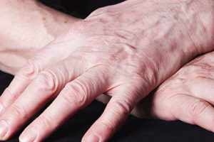 Rheumatism-514378505web