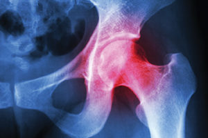 arthritis left hip