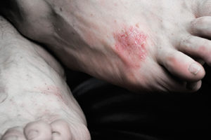 Psoriasis-95580771web2