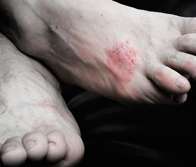 plaque psoriasis foot treatment)