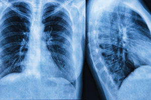 Chest X-ray Image