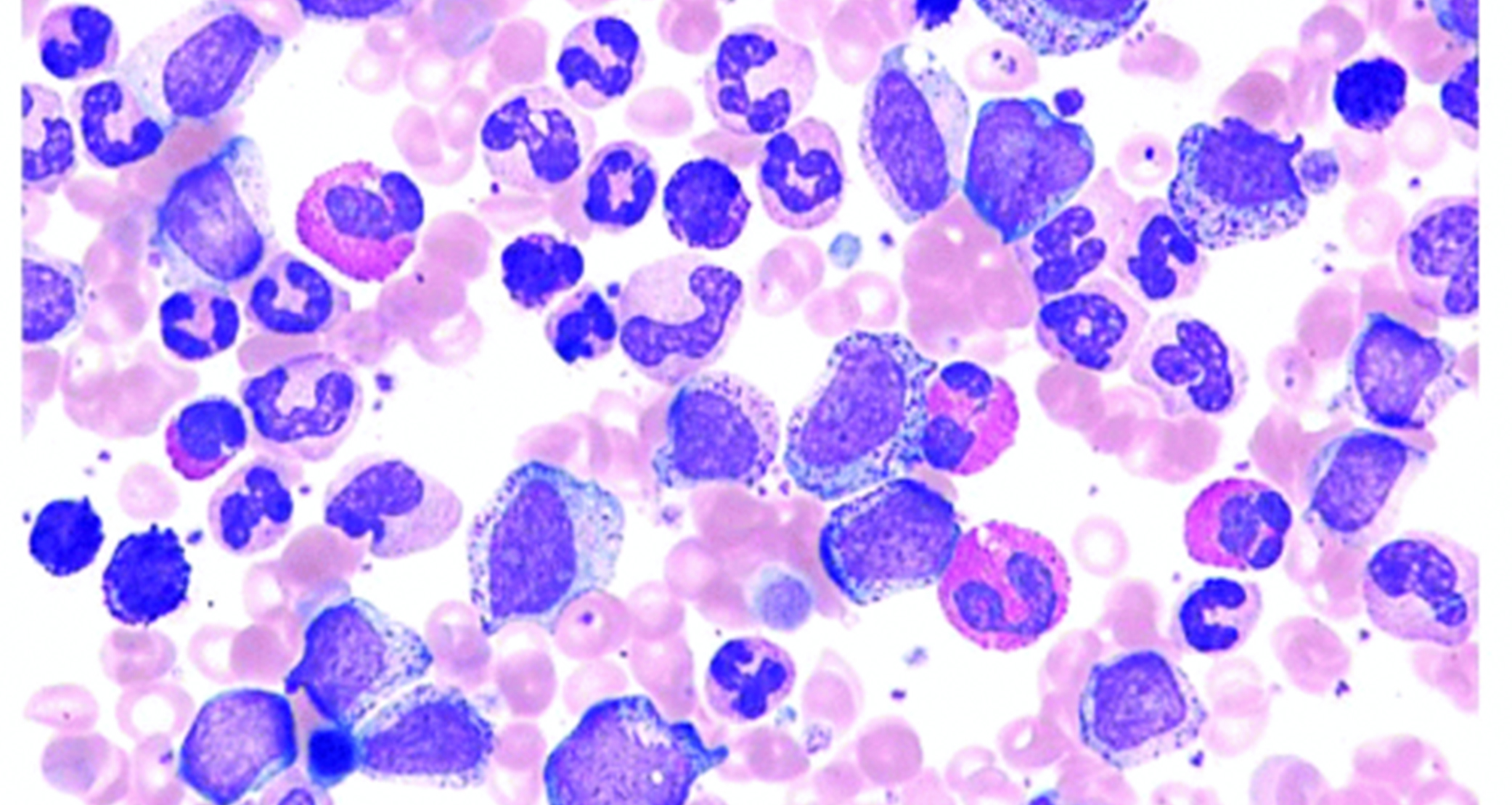 Transformation of the treatment of CML