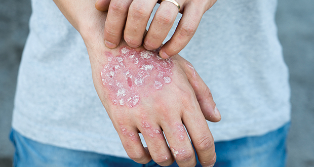 Plaque Psoriasis and Crohn’s Disease: Shared Biology, the IL-12/23 Pathway and Clinical Considerations