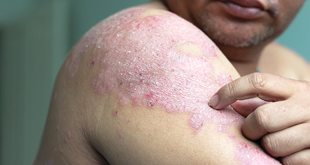 New treatments for managing and measuring psoriasis in Ireland