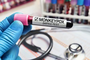 monkeypox-GettyImages-1398984545-620-300x200.jpg