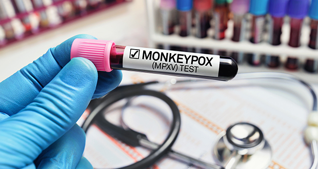 What to know about Monkeypox in Ireland