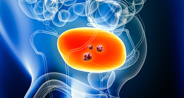 PADCEV (enfortumab vedotin) plus Keytruda (pembrolizumab) is the first and only regimen without platinum-based chemotherapy to improve event-free and overall survival when used before and after surgery in cisplatin-eligible patients with muscle-invasive bladder cancer