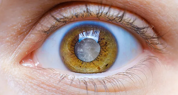 Understanding Cataracts: Causes, Symptoms, and Treatment Options
