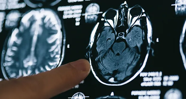 Cell-suppressing treatments may be detrimental to Alzheimer's patients