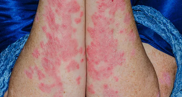 plaque psoriasis