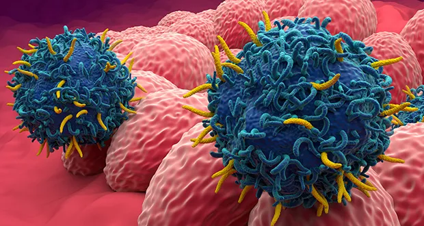 endometrial cancer